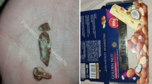 “Шкарлупа замість горіхів”: на Житомирщині дівчина знайшла у шоколадці величезні шматки шкарлупи
