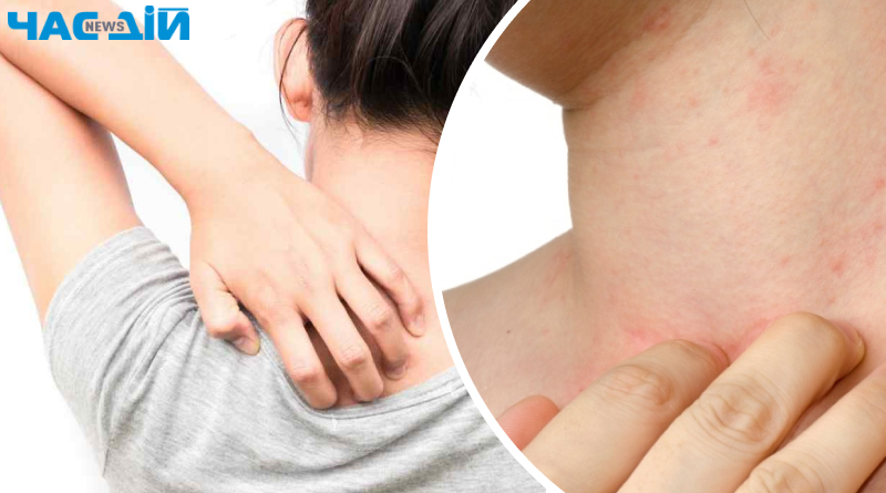 Ефективні способи заспокоїти шкіру від алергії
